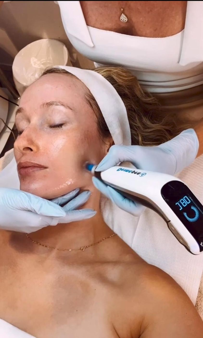 Dermapen microneedling at Skin HQ
